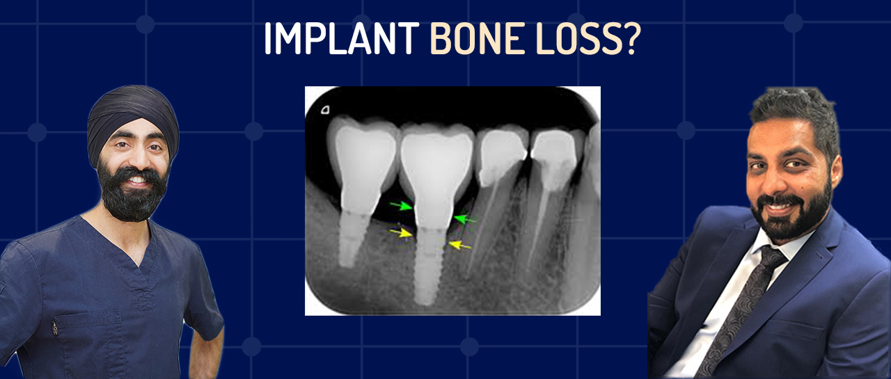 What Should You Do? Bone Loss Around Implants and Screw Loosening