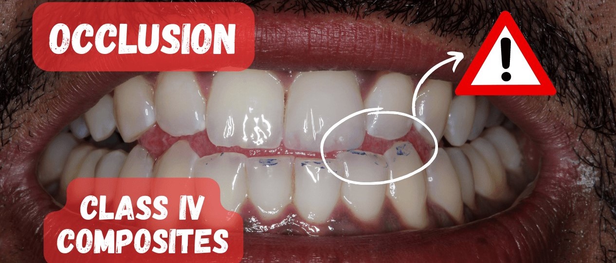Occlusion on Class IV Composite Restorations PDP150 Protrusive