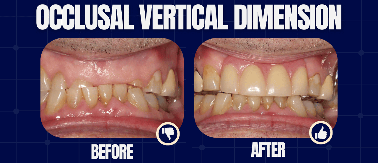 [OCCLUSION MONTH] Vertical Dimension – Don’t Be Scared! – PDP197 ...